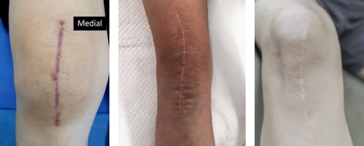 Expert Advice on Sunscreens for Healing Scars and Active Young Athletes